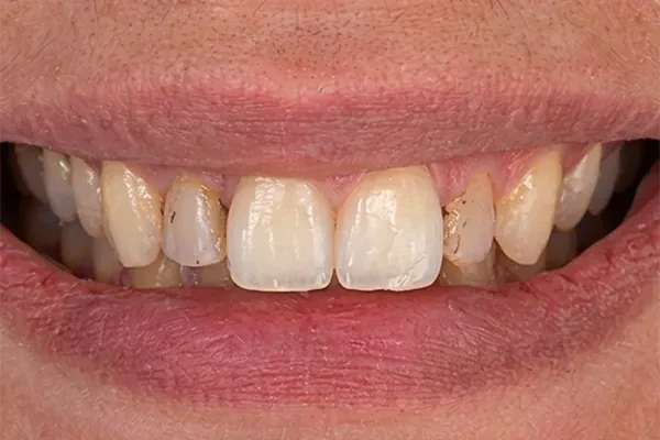 Before dental implant rehabilitation — damaged existing teeth