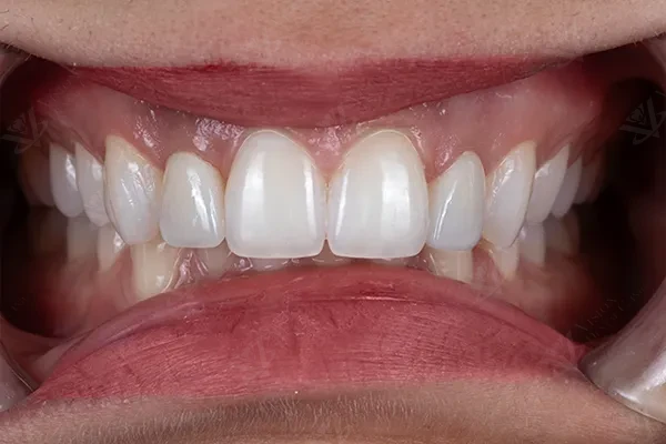 After porcelain veneers smile makeover Abu Dhabi