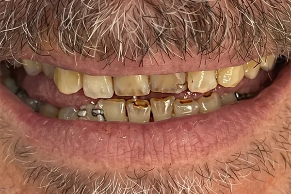 Before full mouth rehabilitation Abu Dhabi