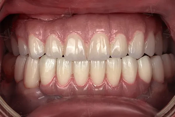 After dental implants restoration Abu Dhabi