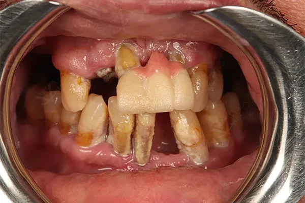 Before dental implants treatment Abu Dhabi
