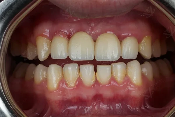 After anterior implant crown Abu Dhabi