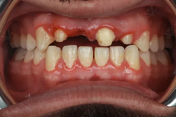 Before anterior implant treatment Abu Dhabi