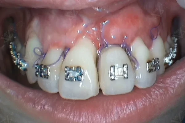 After orthodontic treatment perfect alignment Abu Dhabi