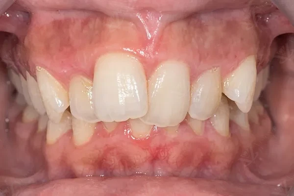 Before orthodontic correction