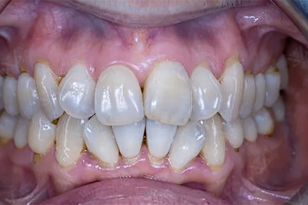 Before teeth alignment