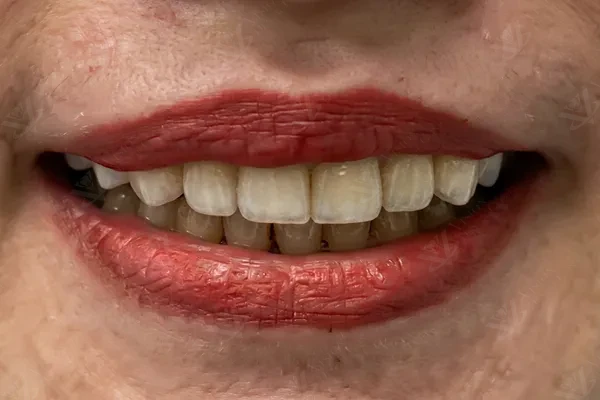 After dental veneers Hollywood Smile Abu Dhabi