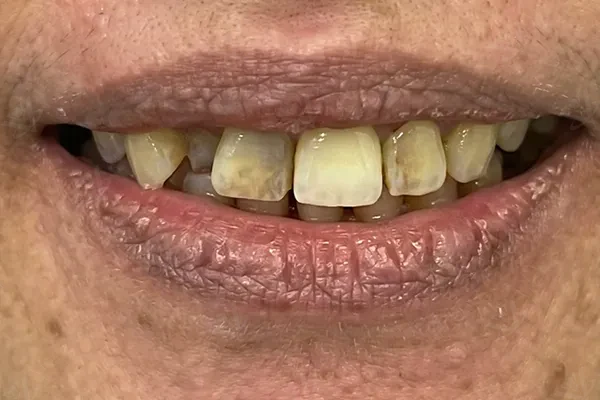 Before dental veneers cosmetic treatment