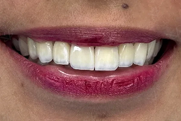 After digital smile design makeover Abu Dhabi