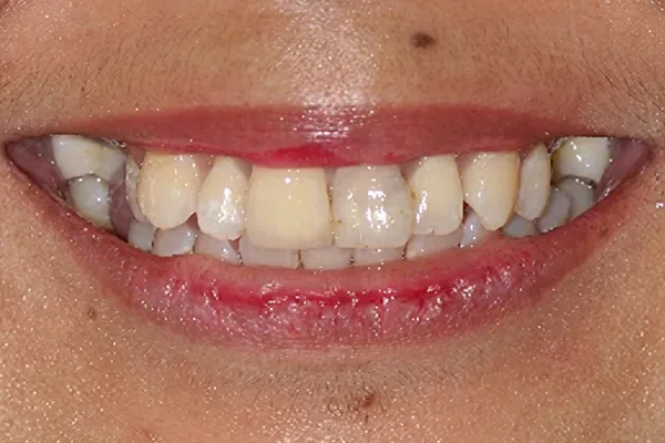 Before digital smile design Abu Dhabi