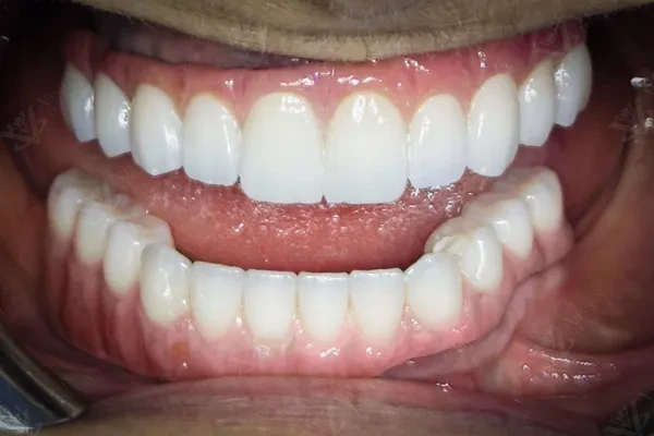 After full-arch implant restoration Abu Dhabi