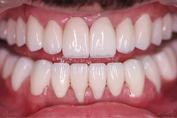 After porcelain veneers smile transformation Abu Dhabi