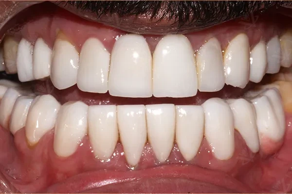 Before porcelain veneers cosmetic dentistry Abu Dhabi