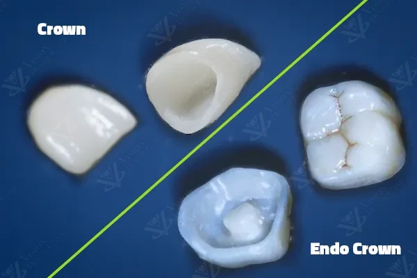 Endocrown vs dental crown comparison Abu Dhabi