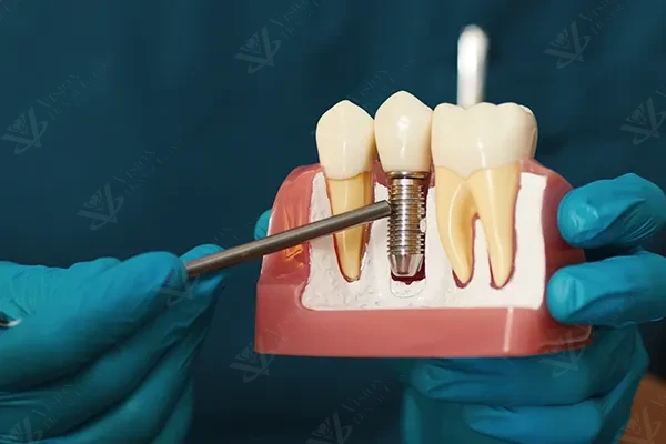 Complete guide to dental implants Abu Dhabi — cost, procedure, benefits