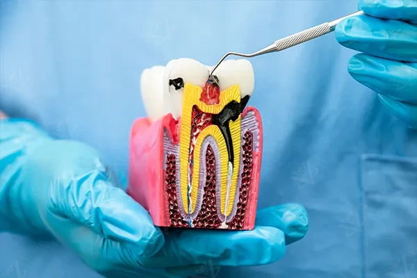Root canal treatment guide Abu Dhabi — painless endodontics