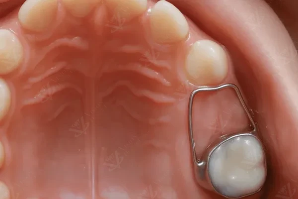 Space maintainers for children pediatric dentistry Abu Dhabi