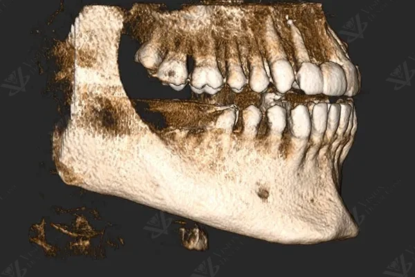 CBCT 3D scan for implant planning