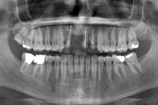 Pre-operative periapical X-ray for anterior implant assessment