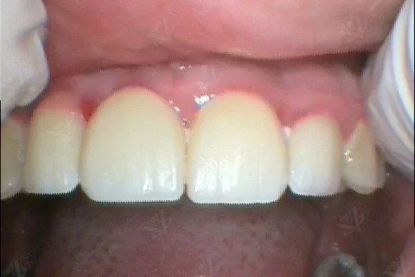 Anterior Implant with Full Crown