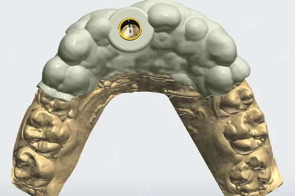 Digital implant guide design