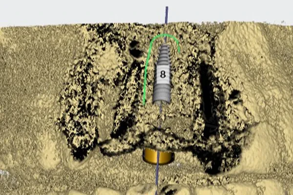 Digital implant planning