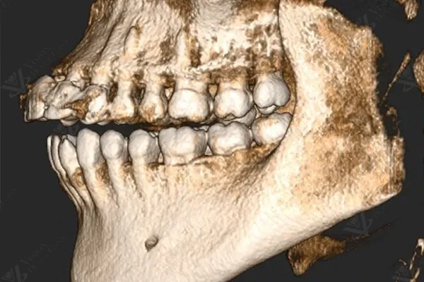 CBCT 3D scan for bridge planning