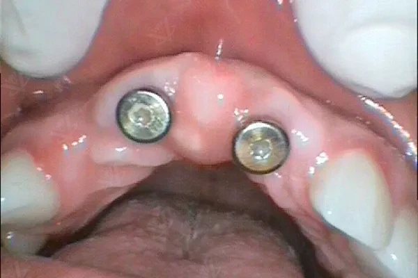 Bridge Replacement with Implant