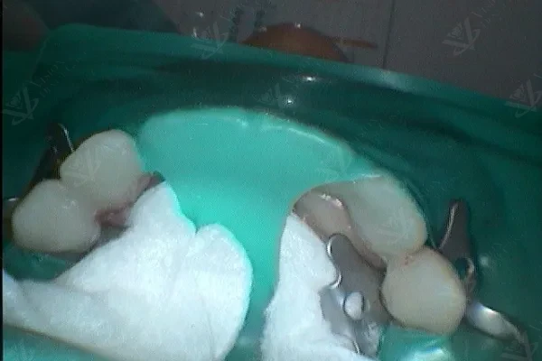 During treatment — bridge preparation