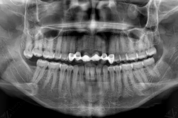 Post-operative X-ray confirming implant bridge placement