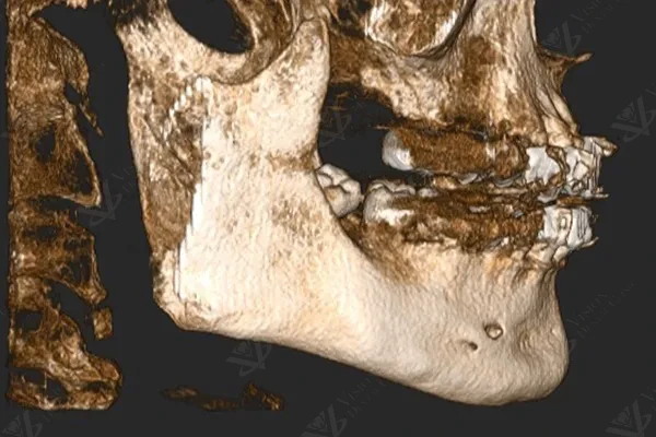 CBCT 3D scan for implant assessment