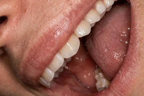Combined Implant & Veneer Rehabilitation