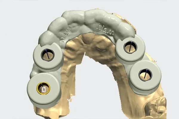 Surgical implant guide