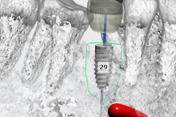 Digital implant planning