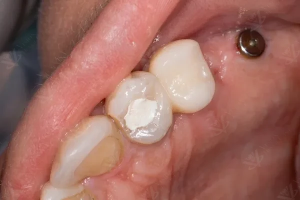 During treatment — implant placed