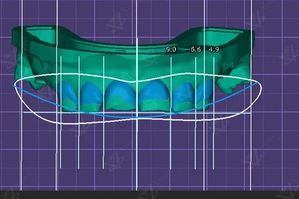 Digital smile design planning for combined implant and veneer treatment