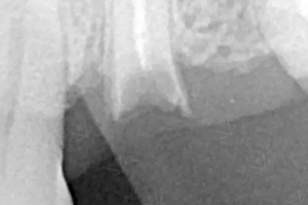 IOPA X-ray — post-extraction assessment