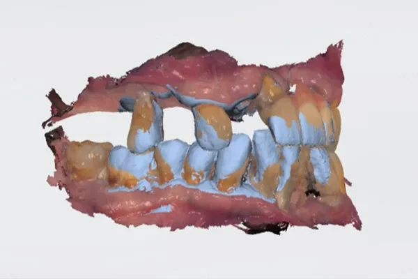 Intra-oral scan — digital impression