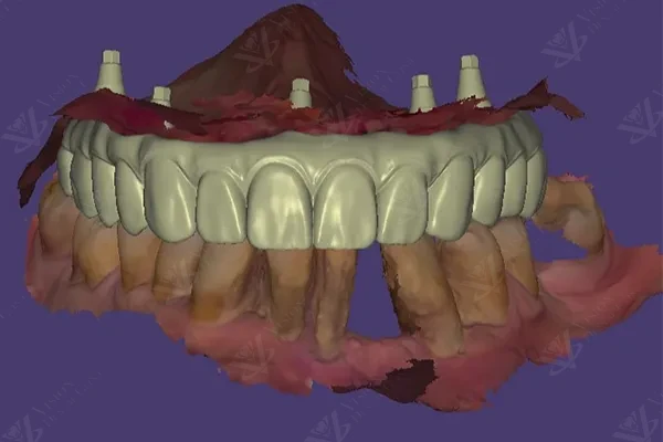 Digital smile design