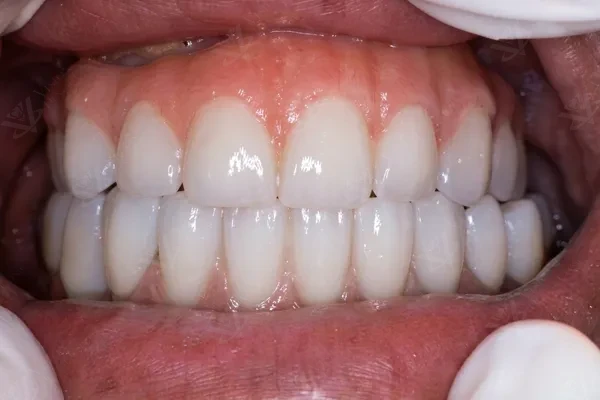 Full-Arch Implant Rehabilitation