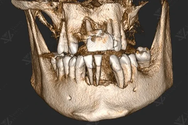 CBCT 3D scan — frontal view
