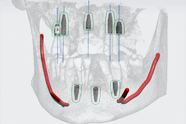Digital implant planning