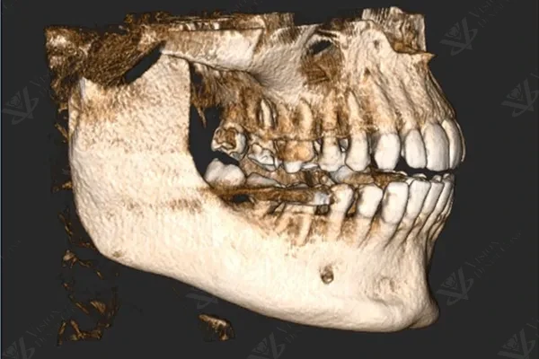 CBCT 3D scan for treatment planning