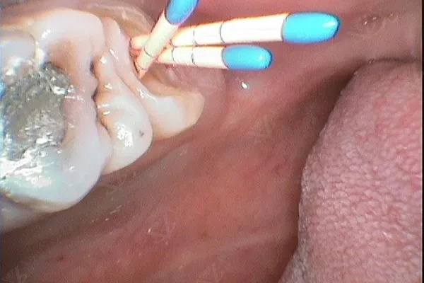 During treatment — root canal
