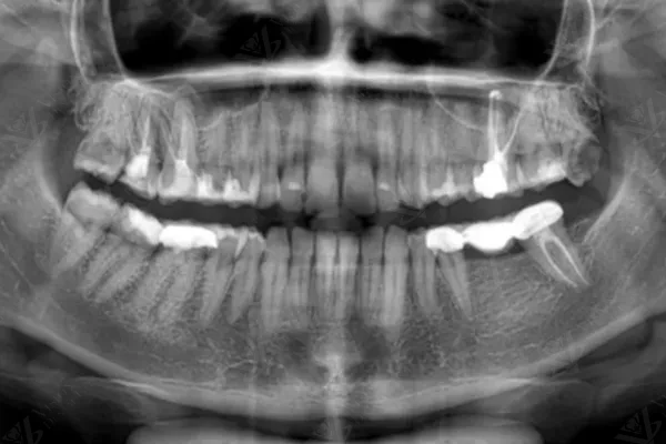 X-ray — treatment verification