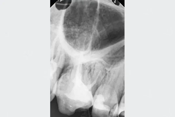 IOPA periapical X-ray for treatment assessment and verification