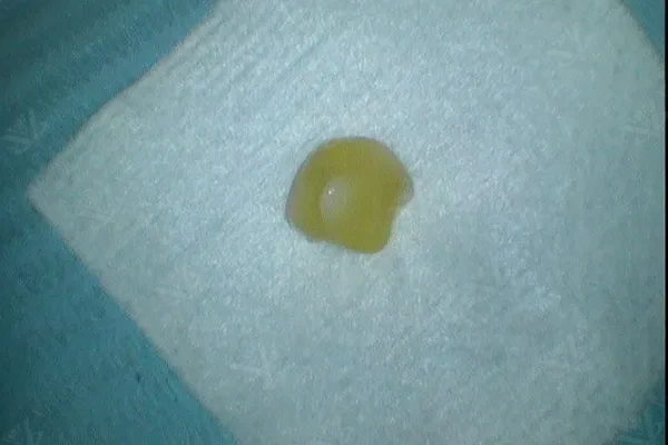 During treatment — onlay preparation