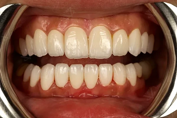 Complete Smile Rehabilitation with Veneers