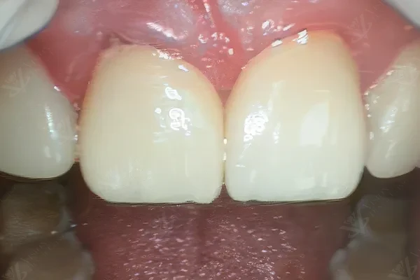 After prosthodontic restoration