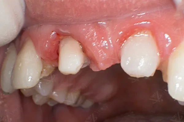 Before prosthodontic treatment